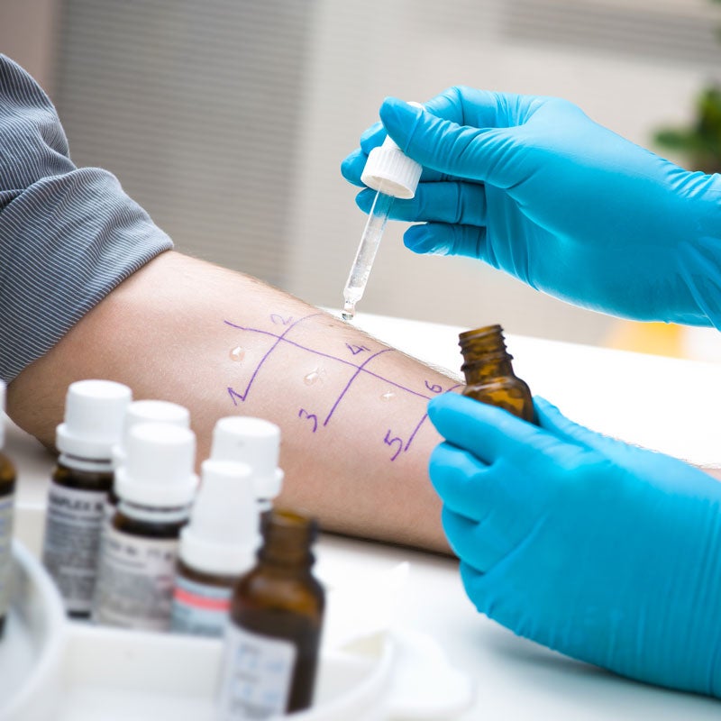 allergy testing